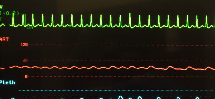 How to Qualify for Disability with SVT (Supraventricular Tachycardia)