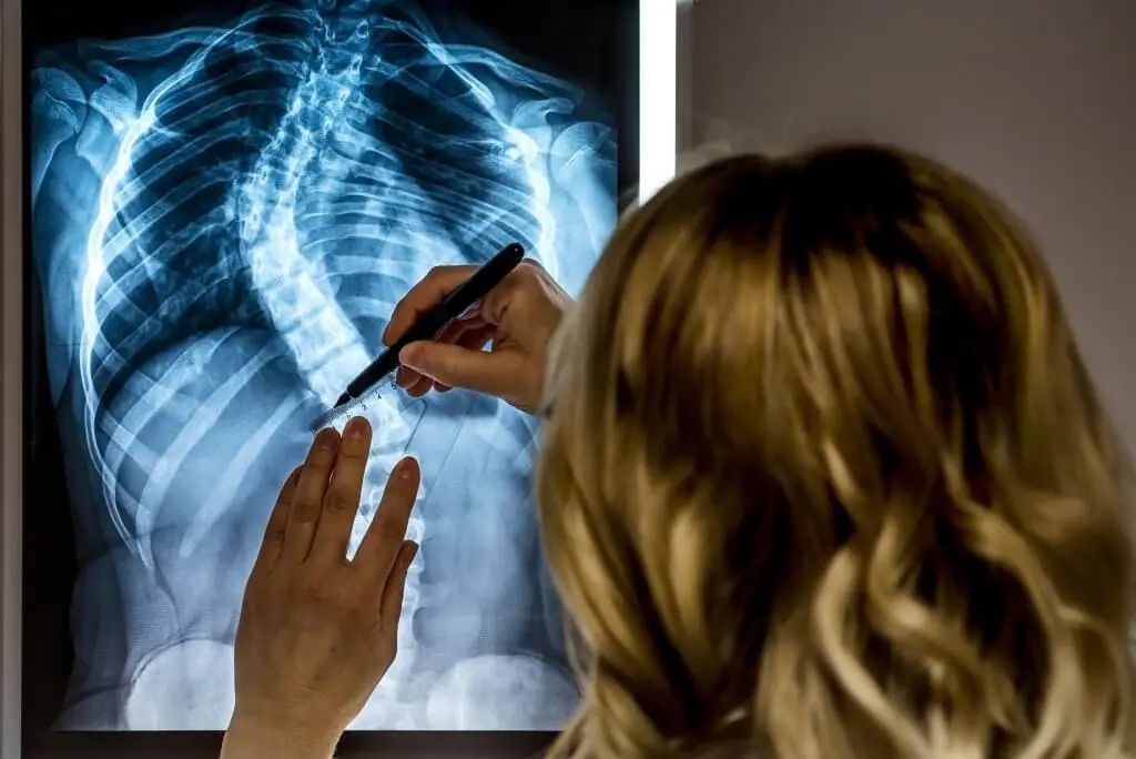 how to get disability benefits for scoliosis