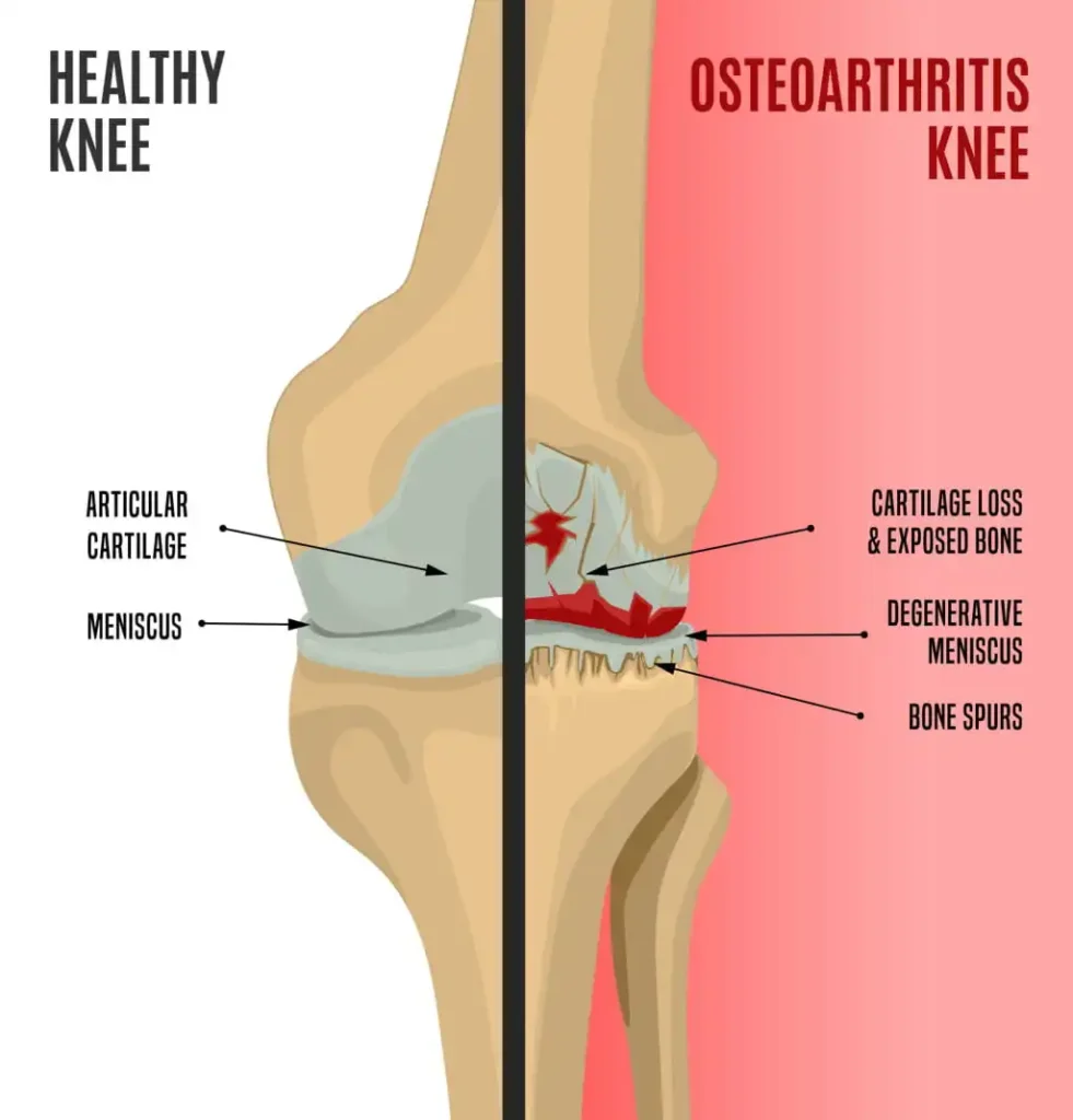 diagram of knee with osteoarthritis